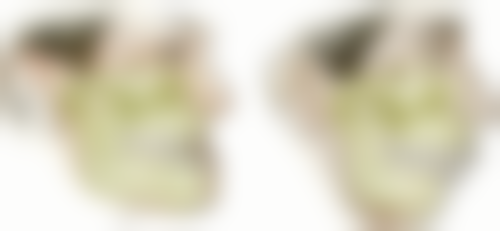 牙齿美白大概需要多少钱