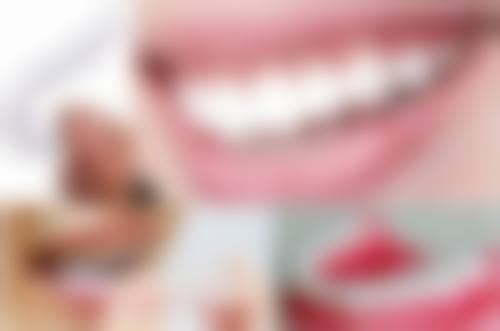 诺贝尔种植牙有哪些型号