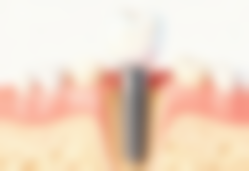 牙齿矫正每次加力都会痛多久？