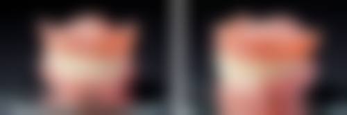 矫正拔掉的牙齿会收回去吗