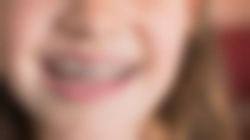 儿童地包天治疗方法与方案