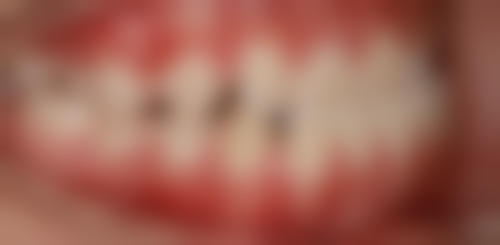 种植牙和镶牙哪个好