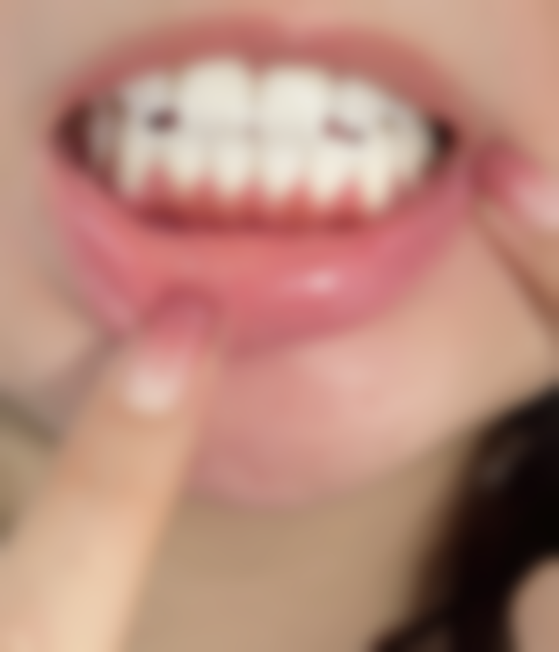 牙齿矫正需要上下牙一起矫正吗