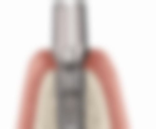 种植牙和烤瓷牙的优缺点对比