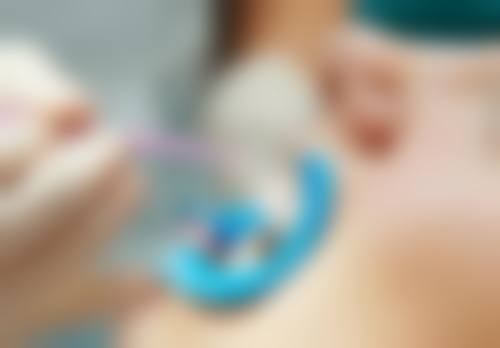 一般拔牙了多久要种植牙