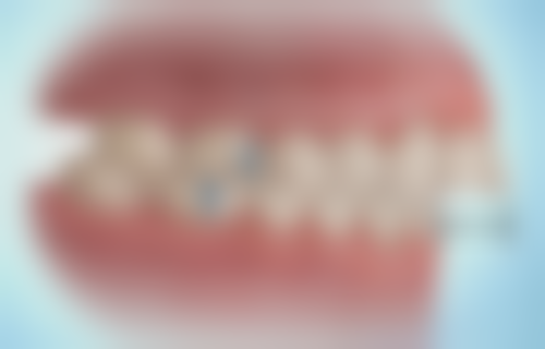 不同人群适合的牙齿美白方法