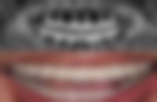 韩国登腾种植牙和德国 camlog 种植体哪个好