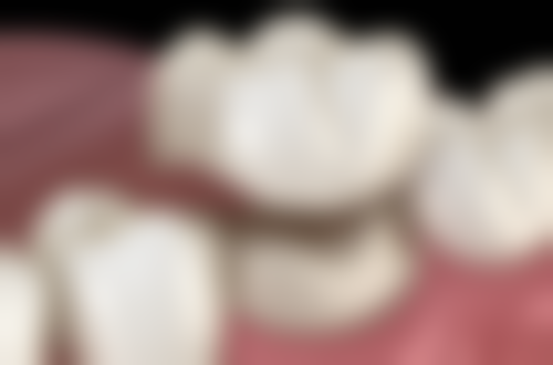 30岁做牙齿矫正有什么后遗症