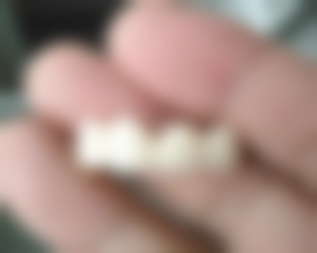 拔牙一年后再做种植牙的情况