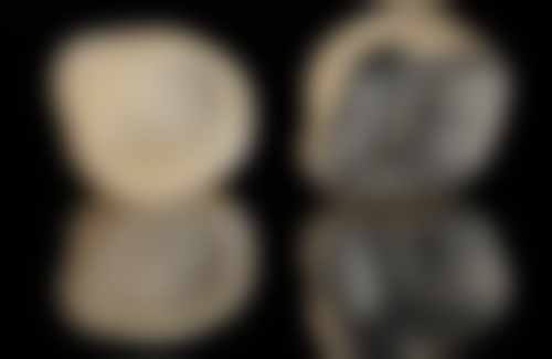 牙齿美白对牙齿伤害大吗