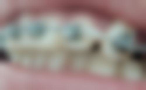 儿童洗牙一次大概多少钱