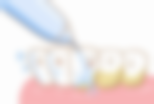 不同类型假牙的特点