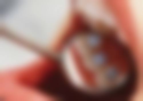 隐形牙套矫正牙齿的原理是什么