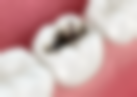 腭裂手术后会裂开吗