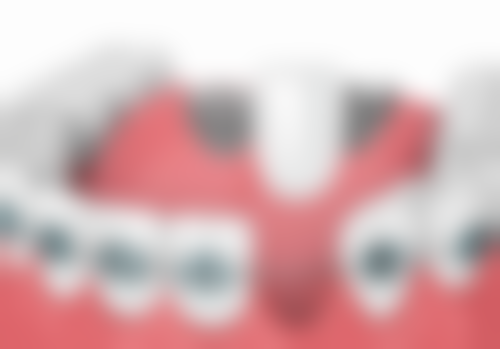 种植牙哪个国内的更好价格也合理