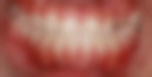 德国种植牙的特点