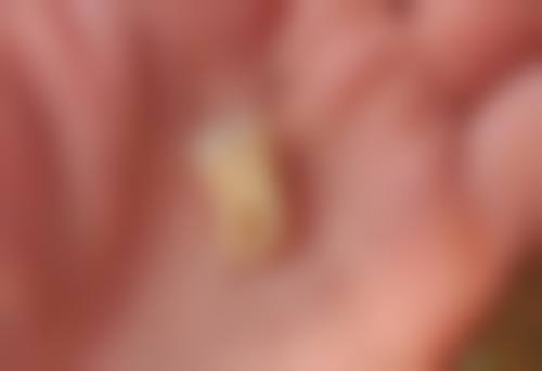 全口种植牙怎么安装的