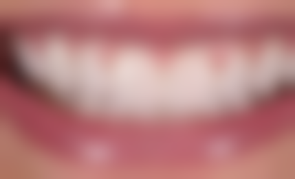 骨质疏松可以做种植牙吗