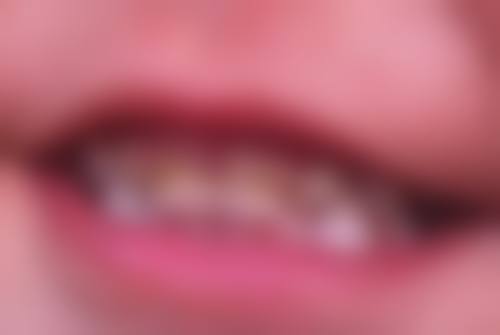 矫正牙齿需要拔智齿吗