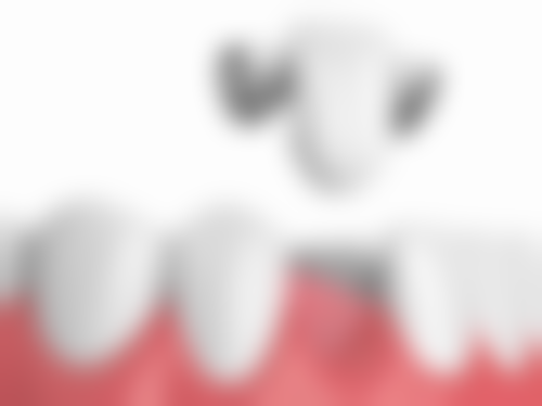 矫正牙齿一般要花多少钱