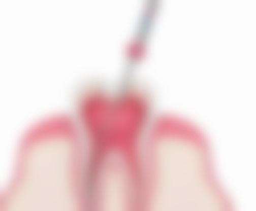 矫正牙齿多少钱价格表