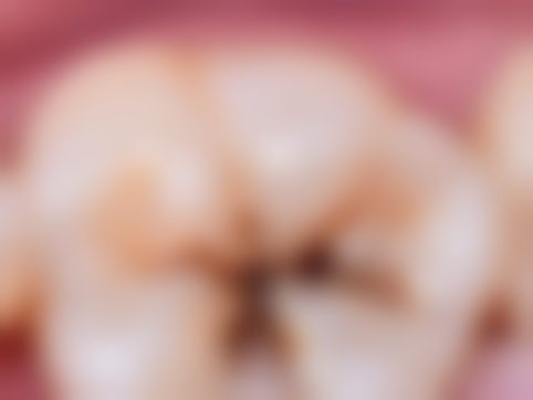 全口种植牙有什么风险和后遗症