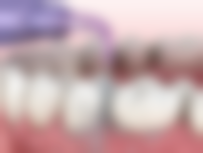 种植牙跟烤瓷牙有什么区别