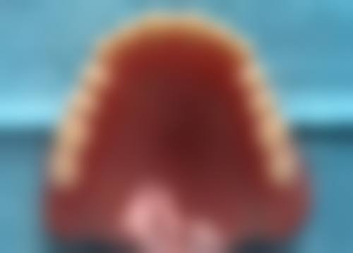 全口种植牙的使用寿命