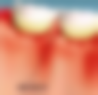 全口种植牙需要多长时间？权威解析种植流程及时间安排，助你快速拥有健康好牙！ 