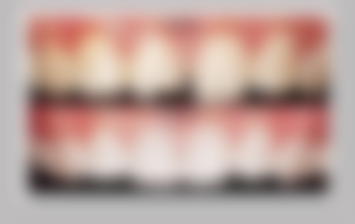 28岁地包天矫正一般多少钱