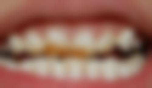 地包天牙齿矫正23岁还能矫正么