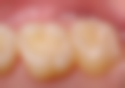 小孩矫正牙齿要拔牙对牙齿以后有影响吗