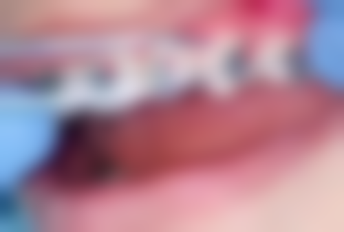 种植牙需要做根管治疗吗多少钱