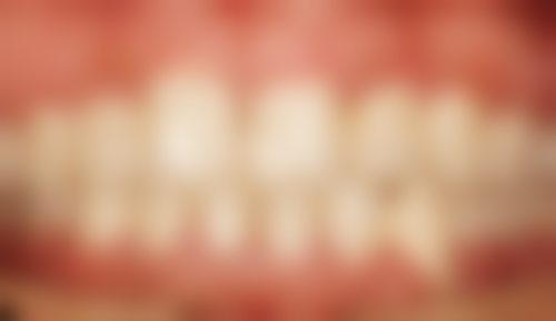 孩子地包天用哪种矫正器？权威解析3种热门矫正器优缺点，助孩子告别地包天！ 