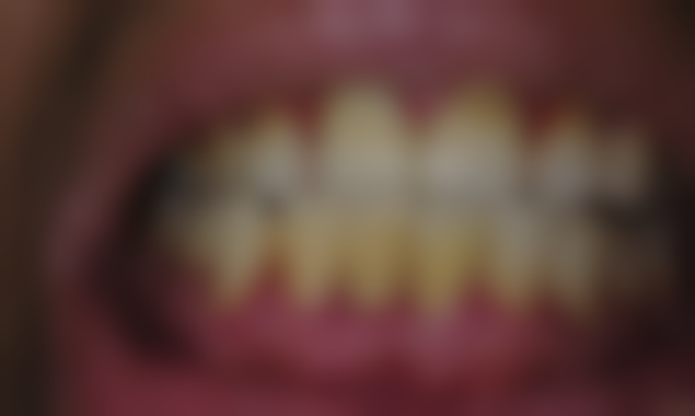 满口种植牙齿多少钱一颗