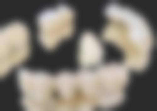 骨性地包天带牙套能矫正吗