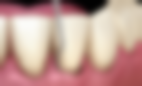 牙齿矫正需要注意什么