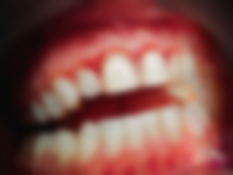 种植与活动假牙、烤瓷牙的区别