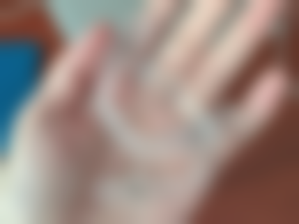 牙齿拔了是镶牙好还是种牙好