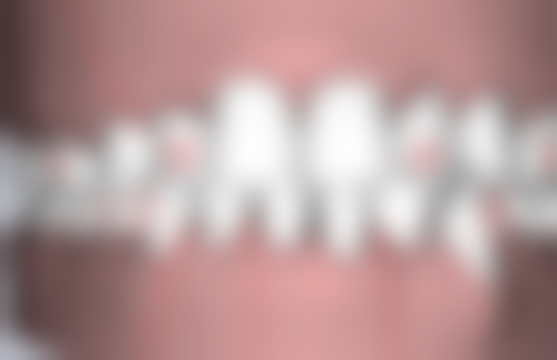 牙齿地包天矫正要拔牙吗