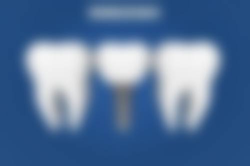 种植与活动假牙、烤瓷牙的区别