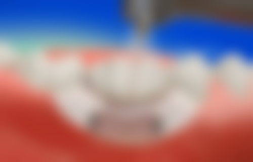 地包天矫正一定要打骨钉吗？看完这5个真实案例及专业解析，让你明白打与不打的利弊！ 