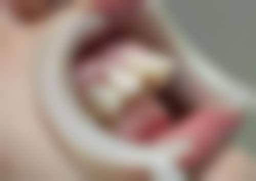 种植牙需要拔掉牙根吗