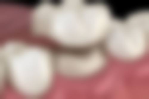 成年之后地包天还会重度吗