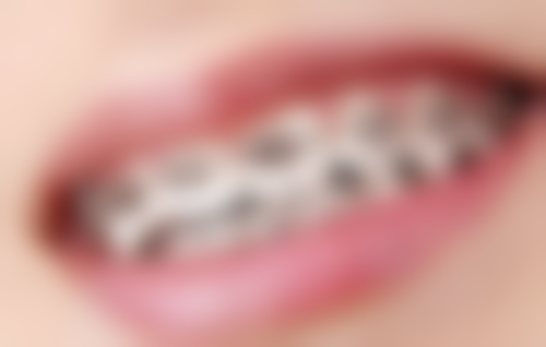 地包天矫正视频全过程