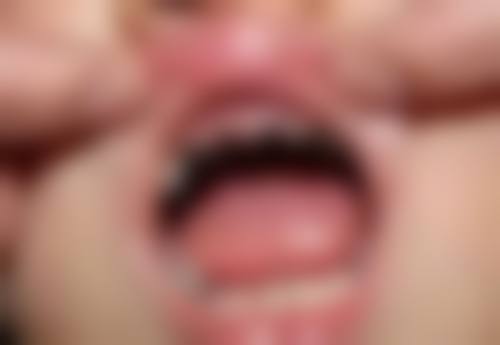 拔牙和矫正是一起做吗