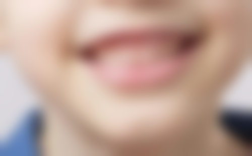 30岁矫正地包天有什么后遗症