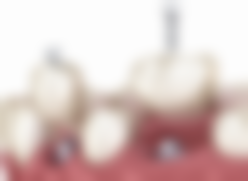 瑞典诺贝尔种植牙系列有哪些种类