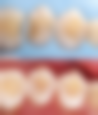 现在的种植牙技术有进步了么