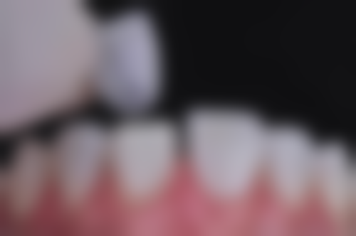 儿童乳牙下午能拔牙吗多少钱